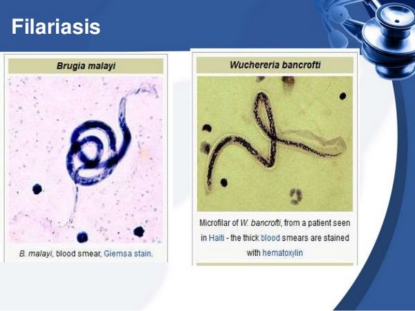 Filariasis (Wuchereria Bancrofti and Brugia Malayi)